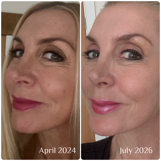 Vikki's Glow Guide - Why I love Skin Boosters